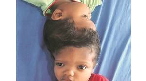 Joined at the skull: rare among twins, separation rarer