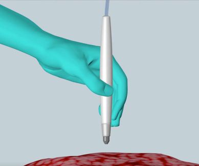 Cancer, cancerous tissue identification, MasSpec pen, University of Texas Austin, diagonstic information, surgical assistance, cancerous cells, metabolites, biomarkers, molecular fingerprint