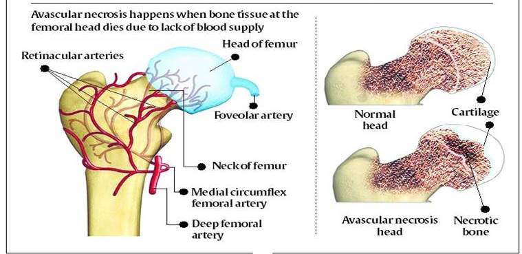 Amid series of surgeries, doctors link hip damage to ... side view of hip bone diagram 