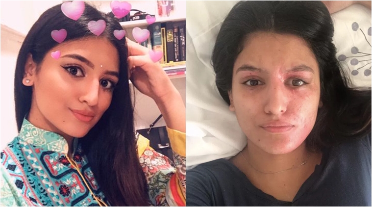 The Acid Attack Survivor Who Shared Her Post Recovery Photos Gets