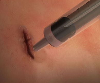 Surgical glue, University of Sydney, Harvard University, MeTro, internal wounds, elastic protein technology, light sensitive molecules, gel-like phase, tissue surfaces, crosslinking treatment, silicone sealants, Harvard Medical School