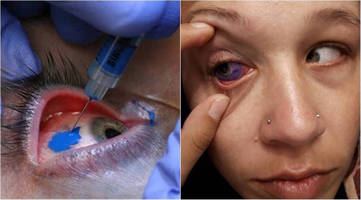 In Graphics This Delhi man is the first Indian to get his eyeballs tattooed   YouTube