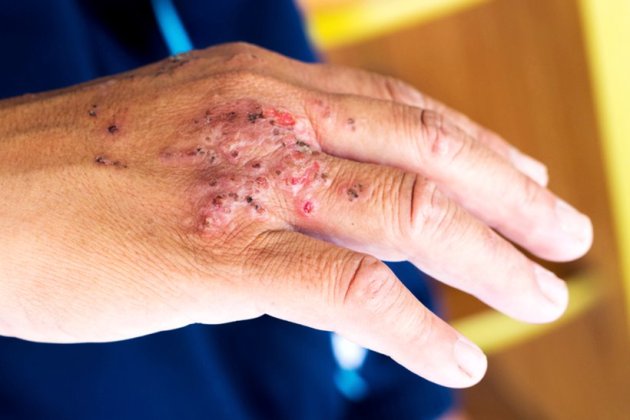 global handwashing day, wash hands, diseases you get if not wash hands, not wash hands diseases, illness, hepatitis a, food poisoning, worm disease, hand foot mouth disease, indian express, indian express news