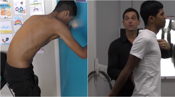 boy with bent back, transformation of a crippled boy, doctor straightens up, doctor heals crippled boy's back, Indian express, Indian express news