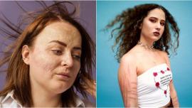 scars, scar photography, photographer captures scars, people with scar, story behind scars, Indian express, Indian express news