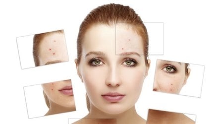 acne, acne increases depression, acne triggers depression, acne results in depression,acne and depression co-relation, acne depressions links, Indian Expres, Indian express news