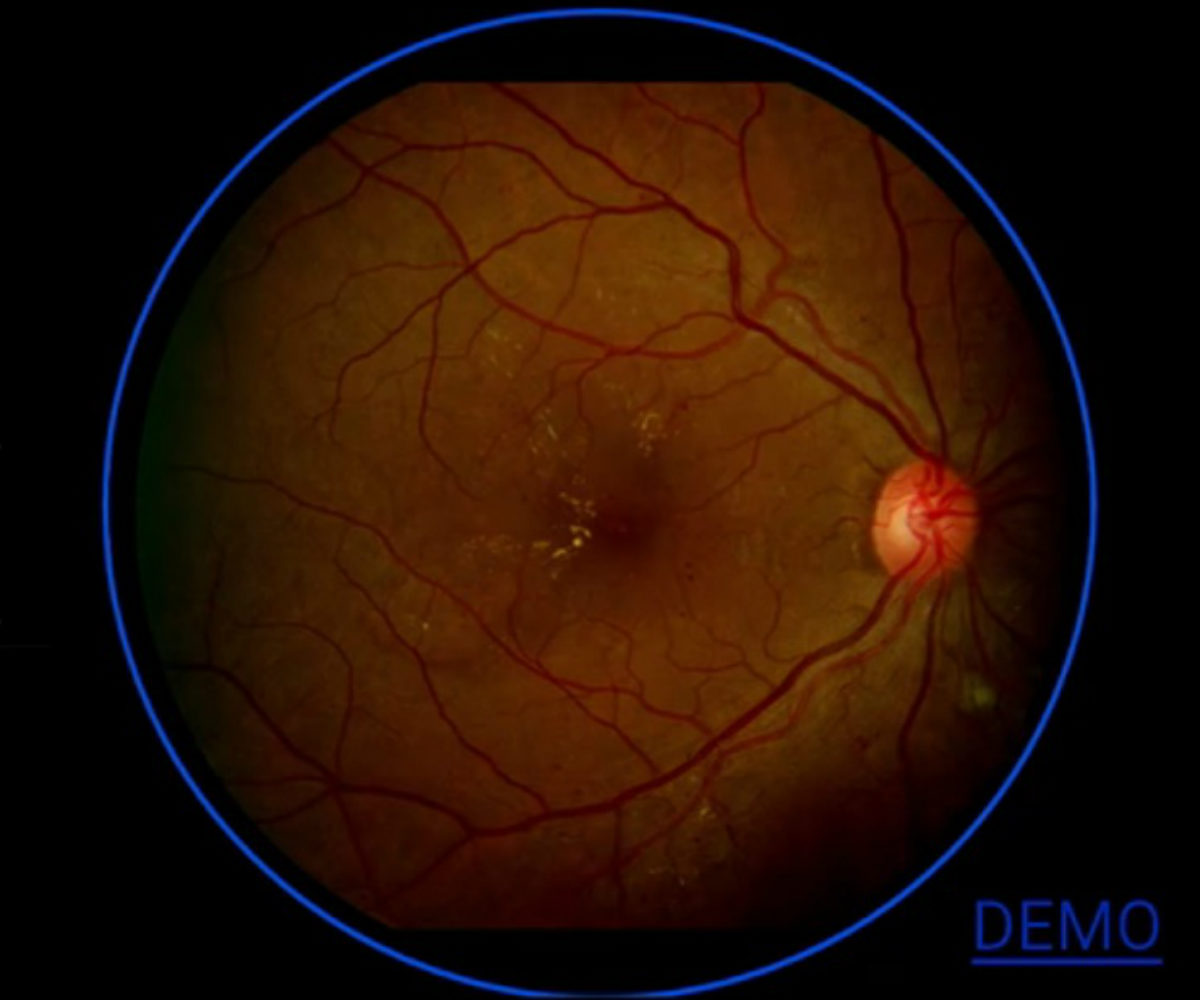 Artificial intelligence, Google AI tech, heart disease, Google Brain Team, retinal scans, attention techniques, blood pressure changes, cardiovascular events, data sets, human anatomy