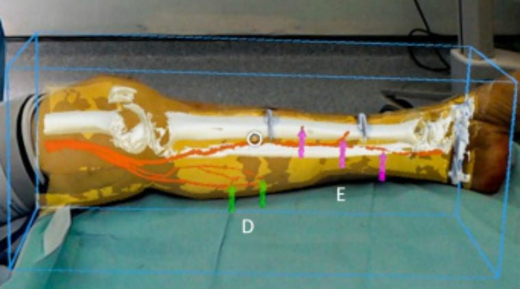 Microsoft HoloLens, reconstructive surgery, Imperial College London, mixed reality, CT scans, augmented reality, tissue damage, AR headsets, blood vessels, 3D models, handheld scanner