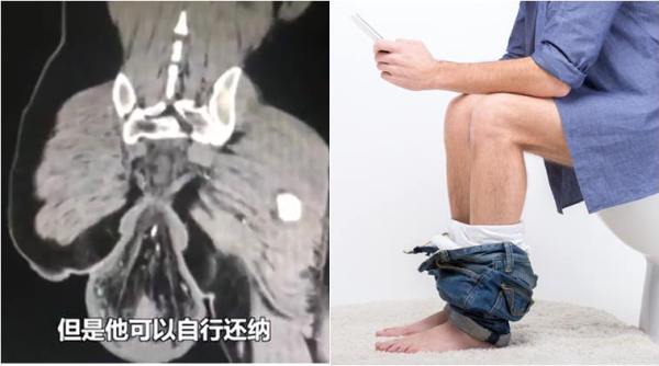 rectum, rectum fell off, rectum fell off playing on mobile phone, rectum fell off while pooping, bizarre news, odd news, viral news, health news, trending news, indian express