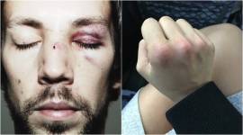 man hit on face_getty_759 woman punch man face Dublin, Leanna Carr, Leanna Carr twitter, woman dublin punch, American tourist in Dublin assaulted, Leanna Carr assualted in Dublin, powerlifter leanna carr, indian express, indian express trending news