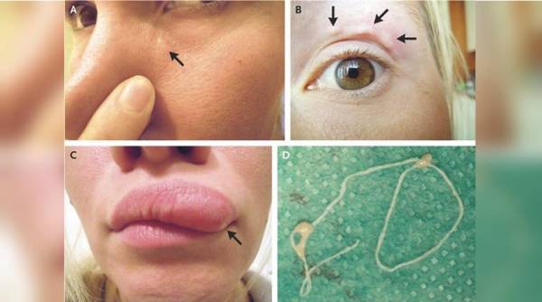 moving lump face story, woman parasite story, woman parasite in face, woman parasite in eye, woman lump story, moving lump, parasite in face, viral news, indian express, indian express news