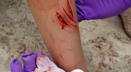 Long Island Shark Investigation Two rare shark attacks reported along New York's Fire Island beaches