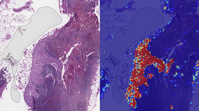 Google, LYNA, Google cancer detection, Google breast cancer, Google breast cancer system, Google Breast cancer detection, Cancer detection