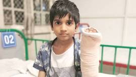 Eight year old bitten by snake, snake bite, reconsutruction surgery,village in Mudkhed, Nanded, Mudkhed rural hospital, Mumbai News, Indian Express 