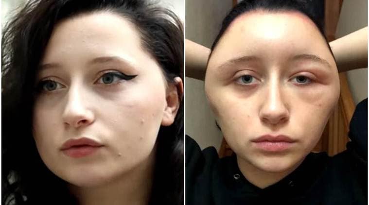 French Woman S Head Transforms Into Light Bulb After Near Fatal Reaction To Hair Dye Trending News The Indian Express