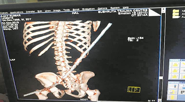 18-year-old impaled after two-storey fall, survives as rod misses vital organs
