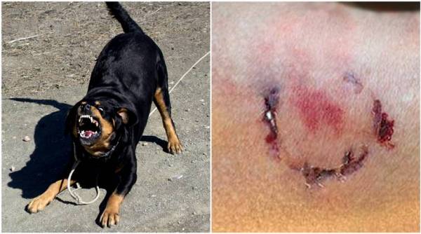 human bite, woman bitten by dog owner, dog owner bites jogger, jogger, woman jogger, dog, dog attack, woman complains of human bite, police, police depatrment, viral story, bizarre story, trending, trending globally, indian express, indian express news
