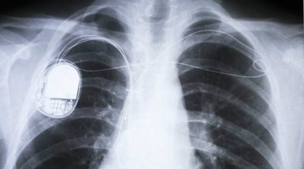 heart, pacemaker, defibrillators, heart implantable device, heart sensors, heart monitoring