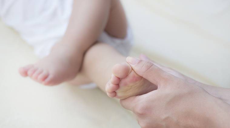 Treating Clubfoot Early May Help A Child Walk Normally Parenting News The Indian Express