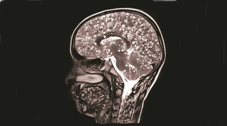 Rare tapeworm infestation case that claimed 18-yr-old’s life featured ...