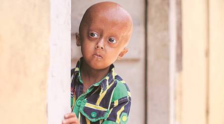 Mumbai: 8-year-old boy with progeria suffers brain stroke, dies