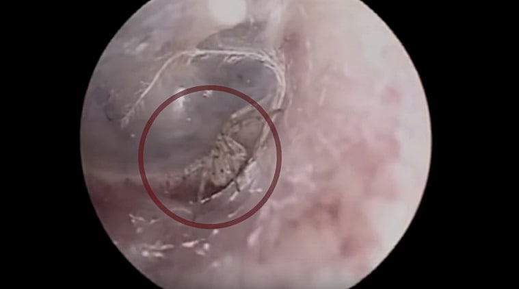 spider in ear, ear inside man ear, spider lives in man ear, odd news, weird news, bizarre news, indian express