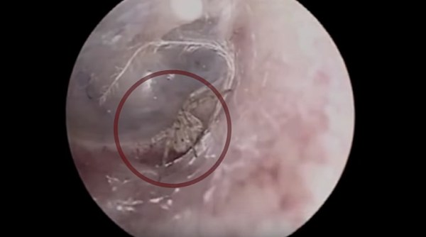 spider in ear, ear inside man ear, spider lives in man ear, odd news, weird news, bizarre news, indian express