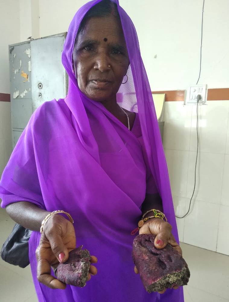 mp woman fakes pregnancy, woman fakes pregnancy, mp woman stillborn baby, madhya pradesh fake pregnancy, mp pregnant woman, mp woman carries dough, indian express