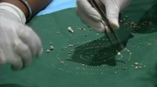Chennai: In rare surgery, dentists extract 526 teeth from seven-year-old's mouth