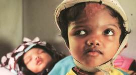 Odisha conjoined twins, Odisha conjoined twins leave AIIMS, conjoined twins jagga balia, cuttack hospital, express big picture, india news, indian express