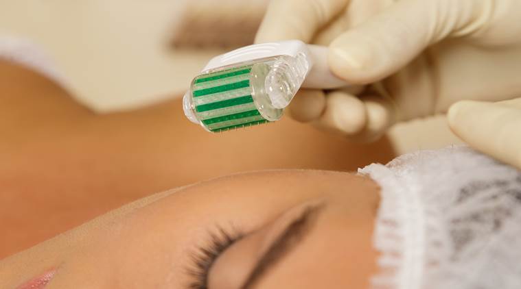 micro-needling, microneedling, indian express, indian express news