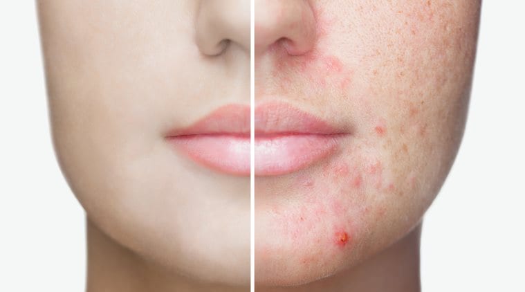 acne, what causes acne, skincare, ways to avoid acne, acne study, indianexpress, indianexpress.com,