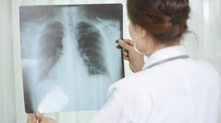 TB, latent TB, active TB, tuberculosis, indianexpress.com, indianexpress, immunosuppression, positive TB, cause of TB,