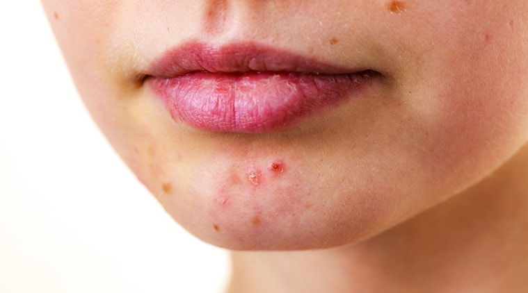 Get rid of acne with these easy ingredients found in your kitchen |  Lifestyle News,The Indian Express