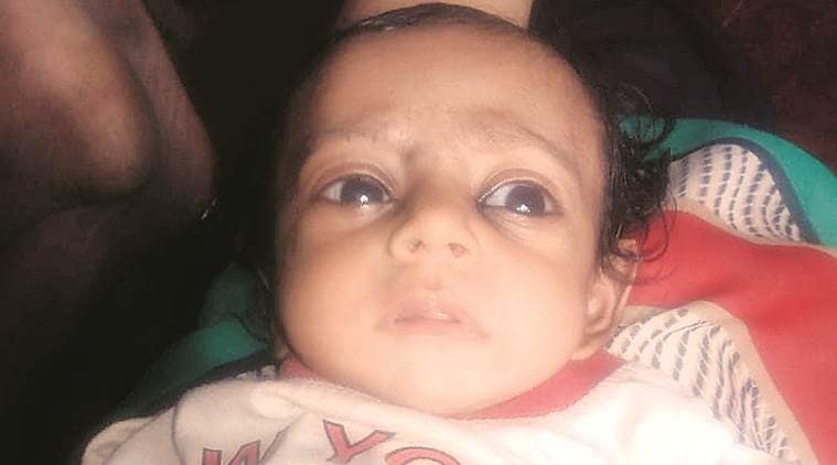 Mumbai baby amputation, Mumbai baby undergoes amputation, Mumbai amputation cases, Mumbai hospitals, Mumbai hospital, Mumbai news, Indian Express