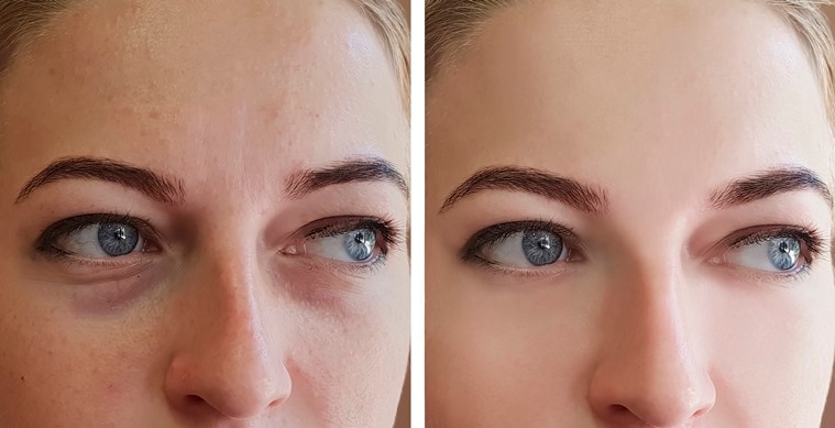  Puffy Eye GEL Instant results – Naturally rapid