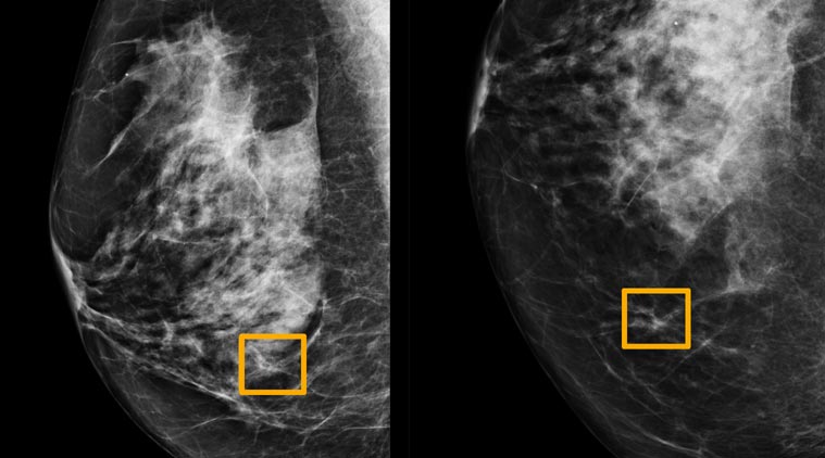 Google, Google AI breast cancer, Google AI detecting breast cancer, Google Breast cancer research, Google DeepMind, Google AI systems