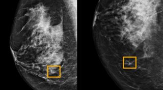 Google, Google AI breast cancer, Google AI detecting breast cancer, Google Breast cancer research, Google DeepMind, Google AI systems