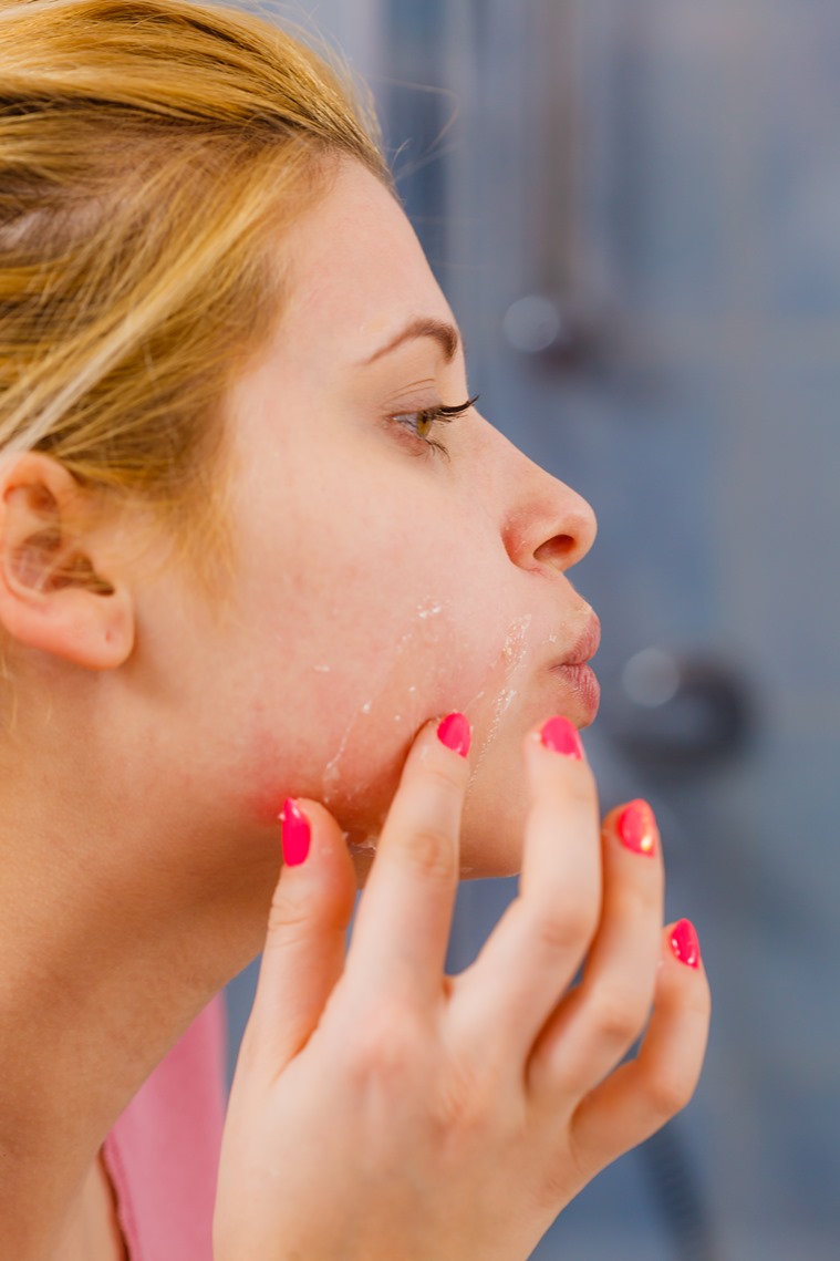 What does it mean when your skin is 'purging'? | Lifestyle News,The