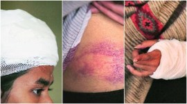 JNU violence: Of the 36 injured, 4 suffered head injuries, rest had bruises on scalp and limbs, records show