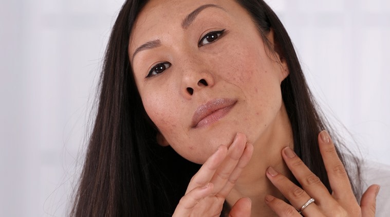 hyperpigmentation and acne scars, hyperpigmentation and acne scars difference, what is hyperpigmentation, what are acne scars. how to heal hyperpigmentation. how to heal acne scars, indian express, lifestyle