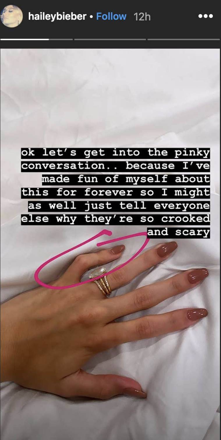 Hailey Baldwin explains her ‘crooked’ fingers. Know about the