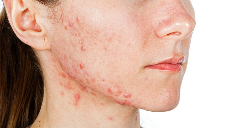 15 Science-Proven Habits That Improve Acne-Prone Skin