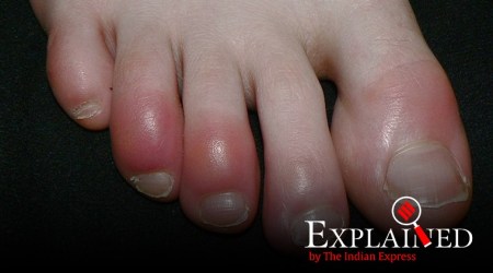 Explained: What is 'covid toe' condition that has left researchers puzzled?