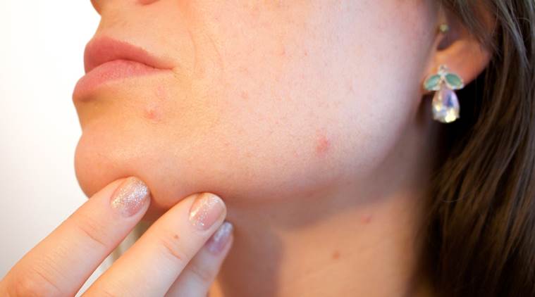 How to heal a popped pimple overnight