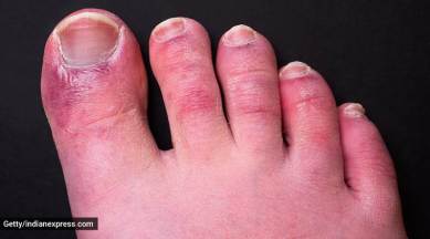 Nếu bạn đang gặp các triệu chứng liên quan đến đôi chân như các đốm đỏ và phù, hãy xem hình ảnh liên quan đến COVID-toes để hiểu rõ hơn về căn bệnh này.