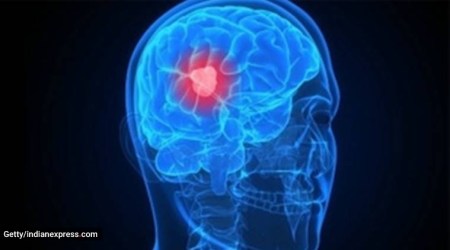 world brain tumour day, brain tumours, indianexpress.com, indianexpress, symptoms of brain tumour, brain tumour treatment,