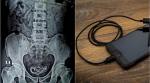 phone charger in urinary tract, man inserts phone charger in penis, man inserts charger for sexual pleasure, doctor remove phone charger from man urinary bladder, odd news, viral news