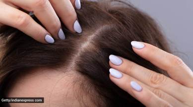 skincare, skincare tips, acne, acne problem, acne on scalp, how to take care of acne, home remedies for acne, indian express news