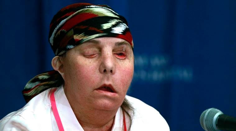 Carmen Blandin Tarleton, US woman face transplant, face transplant, new hampshire woman face transplant, Indian Express